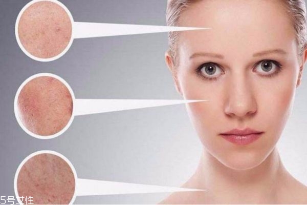 夏天干性皮膚如何護(hù)膚 干性皮膚夏天如何補(bǔ)水保濕 夏天干性皮膚如何護(hù)膚 干性皮膚夏天如何補(bǔ)水保濕