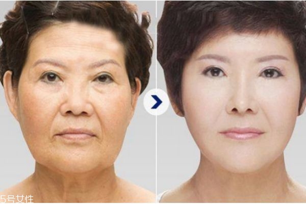 法令紋填充前后照片 填充法令紋后悔死 法令紋填充前后照片 填充法令紋后悔死