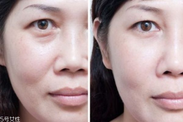 法令紋填充前后照片 填充法令紋后悔死 法令紋填充前后照片 填充法令紋后悔死