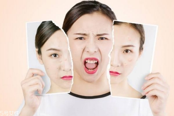 心情會對痘痘有影響嗎 長痘痘的內因有什么呢