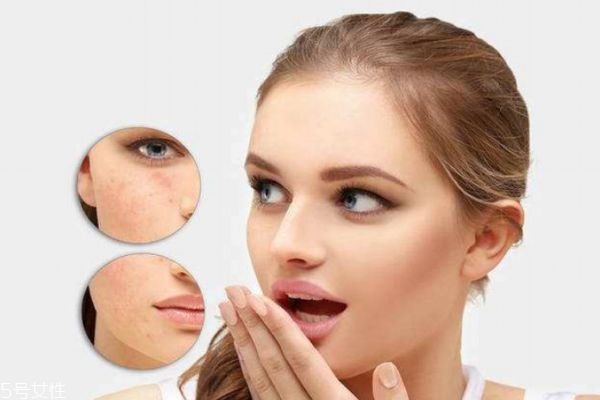 心情會對痘痘有影響嗎 長痘痘的內因有什么呢