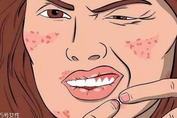 心情會對痘痘有影響嗎 長痘痘的內因有什么呢