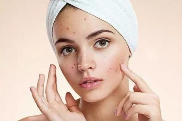 做完果酸需要注意什么 做完果酸后的護(hù)理 做完果酸需要注意什么 做完果酸后的護(hù)理