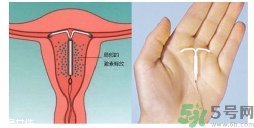 上環(huán)是什么意思？上環(huán)后注意事項(xiàng)有哪些？