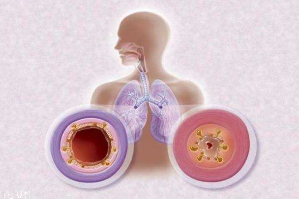 什么是慢性支氣管炎呢 慢性支氣管炎有什么危害呢 什么是慢性支氣管炎呢 慢性支氣管炎有什么危害呢