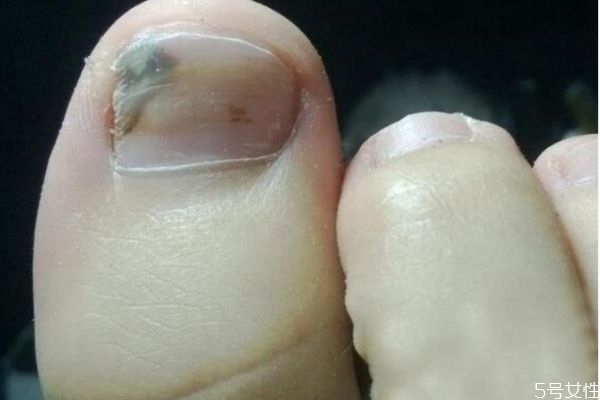 灰指甲是怎么造成的呢 應(yīng)該怎么治療灰指甲呢 灰指甲是怎么造成的呢 應(yīng)該怎么治療灰指甲呢