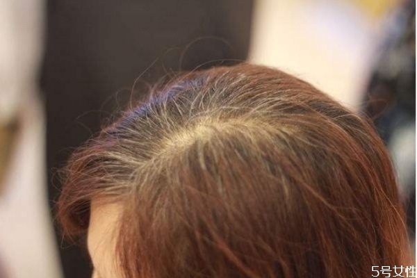 白頭發(fā)是怎樣引起的 怎樣預防白頭發(fā)