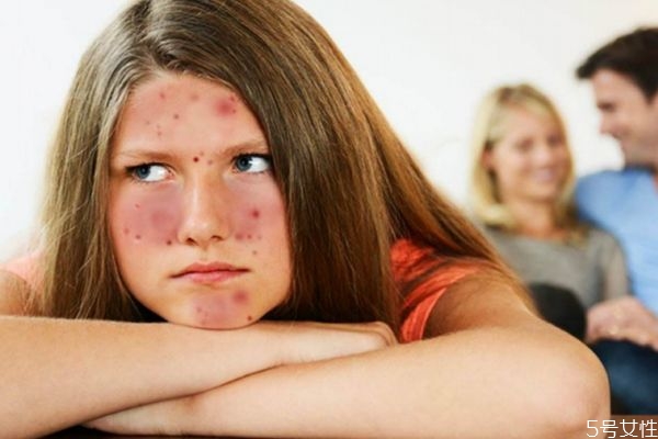 右臉長痘痘是為什么呢 右臉長痘痘的原因是什么呢 右臉長痘痘是為什么呢 右臉長痘痘的原因是什么呢