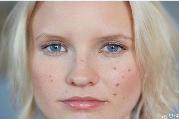 臉上長膿包是為什么呢 造成膿包的原因有什么呢 臉上長膿包是為什么呢 造成膿包的原因有什么呢