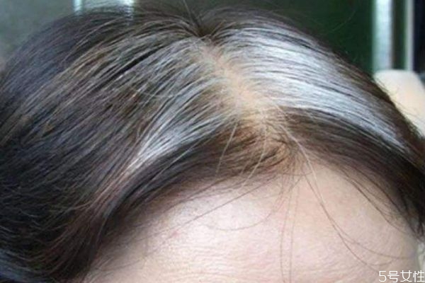 白頭發(fā)為什么越拔越多 白頭發(fā)剪掉還是拔掉好 白頭發(fā)為什么越拔越多 白頭發(fā)剪掉還是拔掉好