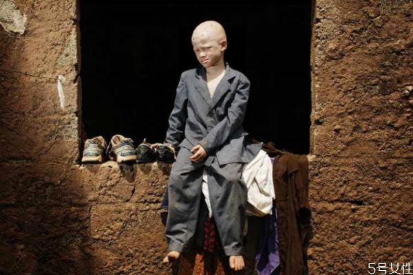 什么是白化病呢 白化病有什么危害呢 什么是白化病呢 白化病有什么危害呢