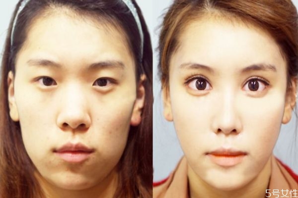 什么人群不能做去腫眼泡手術(shù)呢 做這種手術(shù)有副作用嗎 什么人群不能做去腫眼泡手術(shù)呢 做這種手術(shù)有副作用嗎