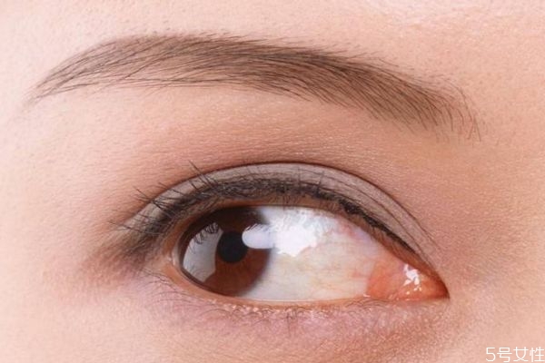 開眼角多久可以恢復呢 開眼角什么時候看沾水呢 開眼角多久可以恢復呢 開眼角什么時候看沾水呢