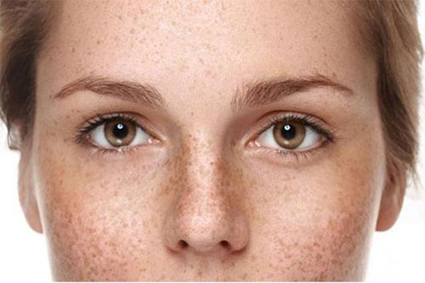 老年斑怎么預(yù)防 出現(xiàn)老年斑要注意什么 老年斑怎么預(yù)防 出現(xiàn)老年斑要注意什么