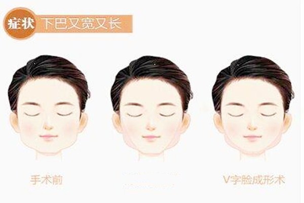 什么人適合下頜角整形手術(shù) 下頜角整形手術(shù)多久能消腫 什么人適合下頜角整形手術(shù) 下頜角整形手術(shù)多久能消腫