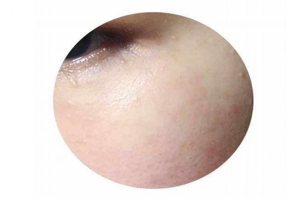 為什么涂眼霜會長脂肪粒呢 什么是脂肪粒呢 為什么涂眼霜會長脂肪粒呢 什么是脂肪粒呢