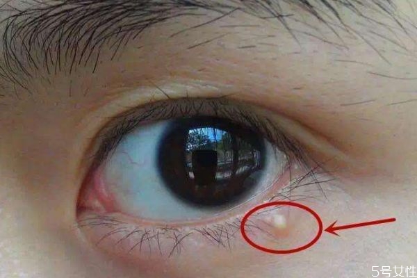 為什么涂眼霜會長脂肪粒呢 什么是脂肪粒呢 為什么涂眼霜會長脂肪粒呢 什么是脂肪粒呢