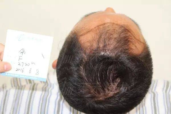 脂溢性脫發(fā)是什么 遺傳性脫發(fā)是脂溢性脫發(fā)嗎 脂溢性脫發(fā)是什么 遺傳性脫發(fā)是脂溢性脫發(fā)嗎