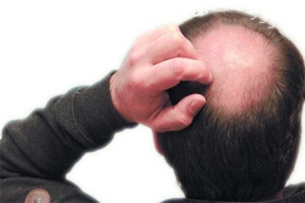 斑禿性脫發(fā)的原因有哪些 斑禿脫發(fā)的表現(xiàn) 斑禿性脫發(fā)的原因有哪些 斑禿脫發(fā)的表現(xiàn)