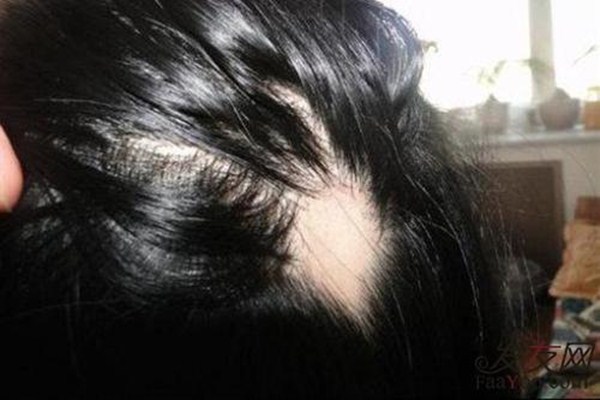 斑禿性脫發(fā)的原因有哪些 斑禿脫發(fā)的表現(xiàn) 斑禿性脫發(fā)的原因有哪些 斑禿脫發(fā)的表現(xiàn)