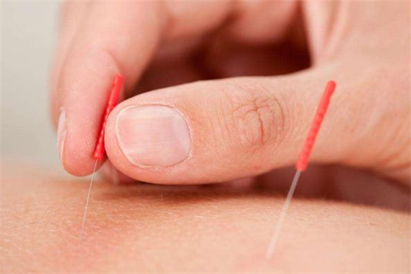 針灸減肥價格是多少 針灸減肥會反彈嗎 針灸減肥價格是多少 針灸減肥會反彈嗎
