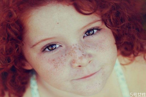 雀斑可以預(yù)防嗎 如何預(yù)防雀斑呢 雀斑可以預(yù)防嗎 如何預(yù)防雀斑呢