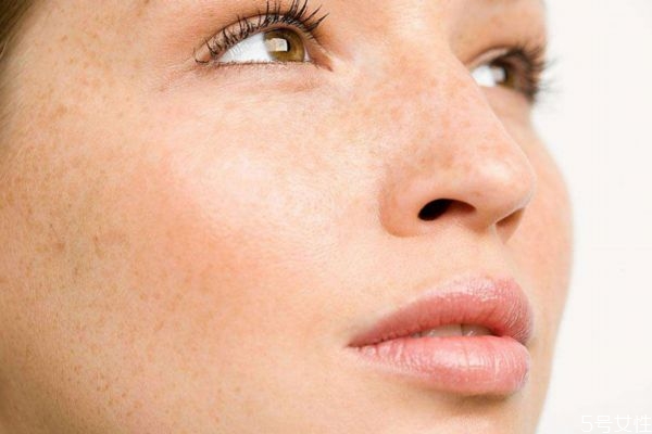 雀斑可以預(yù)防嗎 如何預(yù)防雀斑呢 雀斑可以預(yù)防嗎 如何預(yù)防雀斑呢