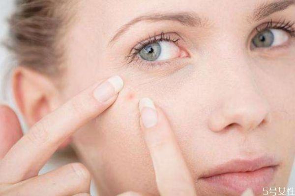 下巴長痘痘怎么消除 怎樣健康去痘痘 下巴長痘痘怎么消除 怎樣健康去痘痘