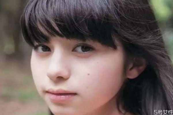 臉部的痣可以怎么去除呢 去除臉部痣的方法有什么呢 臉部的痣可以怎么去除呢 去除臉部痣的方法有什么呢