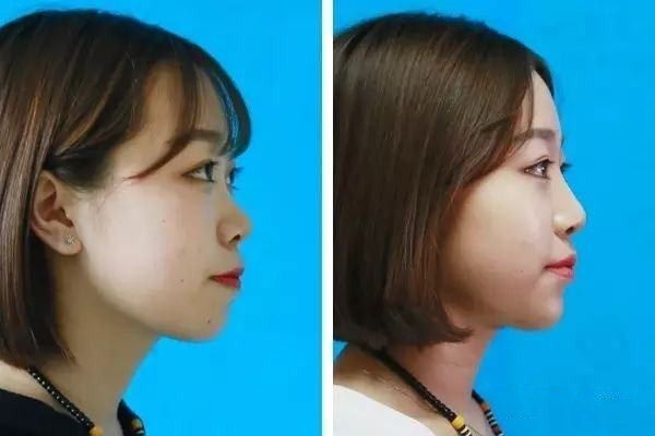 自體脂肪豐下巴好不好 自體脂肪豐下巴效果怎么樣 自體脂肪豐下巴好不好 自體脂肪豐下巴效果怎么樣