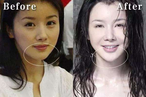 自體脂肪豐下巴好不好 自體脂肪豐下巴效果怎么樣 自體脂肪豐下巴好不好 自體脂肪豐下巴效果怎么樣