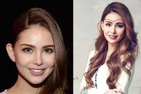 豐蘋果肌的方法有哪些 哪些人適合填充蘋果肌 豐蘋果肌的方法有哪些 哪些人適合填充蘋果肌