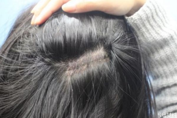 為什么會長白頭發(fā)呢 白頭發(fā)形成的原因有什么呢 為什么會長白頭發(fā)呢 白頭發(fā)形成的原因有什么呢