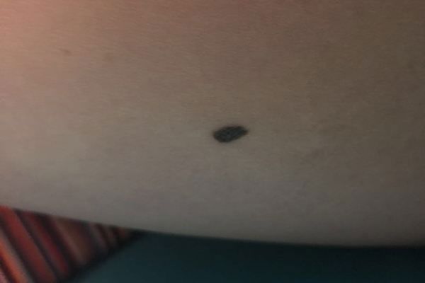 黑色素瘤是什么 什么原因會導致黑色素瘤 黑色素瘤是什么 什么原因會導致黑色素瘤