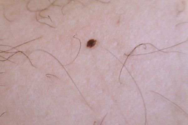 黑色素瘤是什么 什么原因會導致黑色素瘤 黑色素瘤是什么 什么原因會導致黑色素瘤