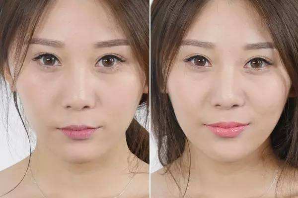 嘟嘟唇豐唇的特點 打完嘟嘟唇多久可以涂口紅 嘟嘟唇豐唇的特點 打完嘟嘟唇多久可以涂口紅