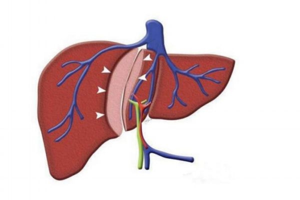 什么是甲肝呢 甲肝有什么危害呢 什么是甲肝呢 甲肝有什么危害呢