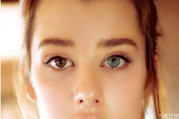 什么是瞳孔異色癥呢 瞳孔異色癥有什么危害嗎 什么是瞳孔異色癥呢 瞳孔異色癥有什么危害嗎