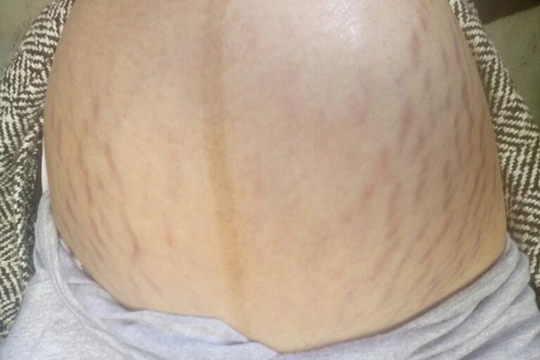 黑色妊娠紋怎么消除 消除妊娠紋的最佳時(shí)間 黑色妊娠紋怎么消除 消除妊娠紋的最佳時(shí)間