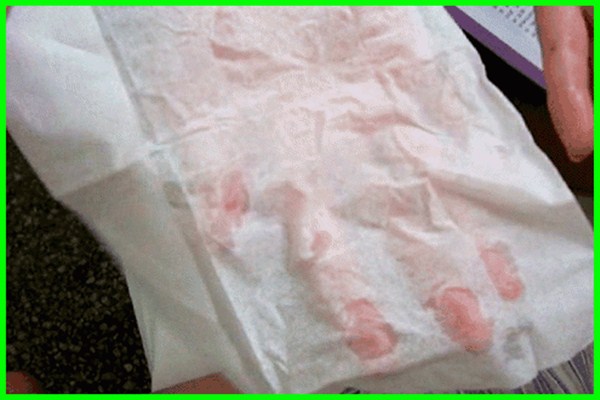 多汗癥是什么 多汗癥出汗程度怎么分級(jí)的 多汗癥是什么 多汗癥出汗程度怎么分級(jí)的