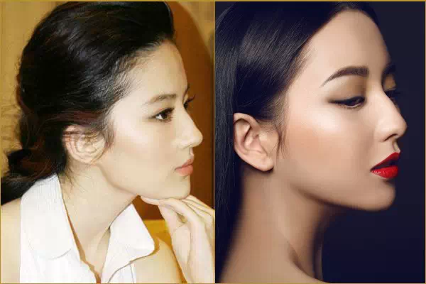 墊鼻根好嗎 怎樣降低墊鼻根的手術風險 墊鼻根好嗎 怎樣降低墊鼻根的手術風險