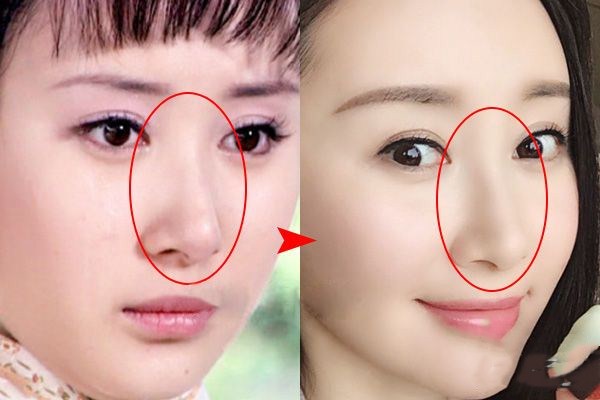 玻尿酸隆鼻會(huì)失敗嗎 玻尿酸隆鼻后的注意事項(xiàng) 玻尿酸隆鼻會(huì)失敗嗎 玻尿酸隆鼻后的注意事項(xiàng)