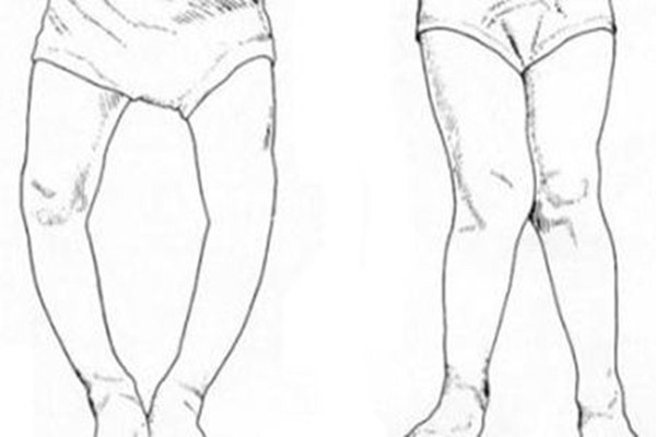 為什么會導(dǎo)致佝僂病 佝僂病前期癥狀有哪些 為什么會導(dǎo)致佝僂病 佝僂病前期癥狀有哪些