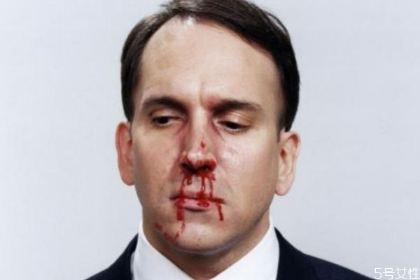 鼻子出血應(yīng)該怎么辦呢 鼻子出血如何治療呢 鼻子出血應(yīng)該怎么辦呢 鼻子出血如何治療呢