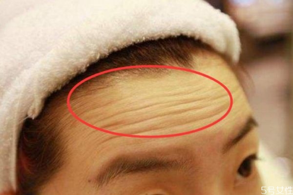 解決抬頭紋的辦法有什么呢 什么可以去除抬頭紋呢 解決抬頭紋的辦法有什么呢 什么可以去除抬頭紋呢