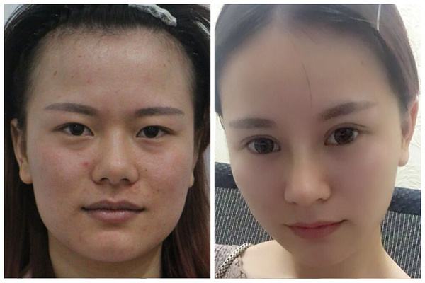 5s重瞼術(shù)有失敗的嗎 5s重瞼術(shù)的優(yōu)點(diǎn)有哪些 5s重瞼術(shù)有失敗的嗎 5s重瞼術(shù)的優(yōu)點(diǎn)有哪些