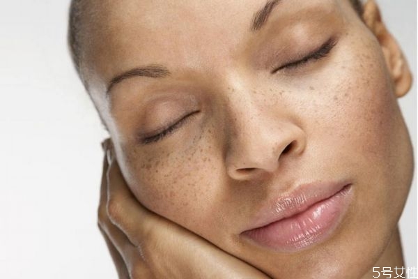 雀斑是天生的嗎 雀斑可以消除嗎 雀斑是天生的嗎 雀斑可以消除嗎
