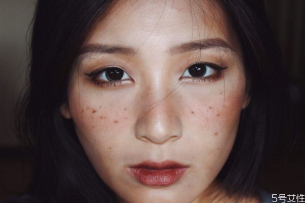 雀斑是天生的嗎 雀斑可以消除嗎 雀斑是天生的嗎 雀斑可以消除嗎