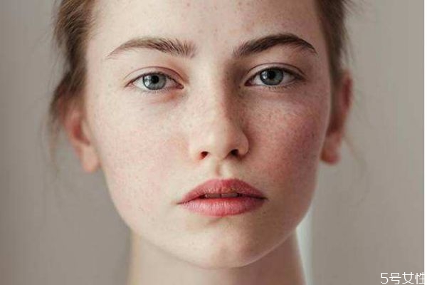 如何淡化雀斑呢 淡化雀斑的方法有什么呢 如何淡化雀斑呢 淡化雀斑的方法有什么呢