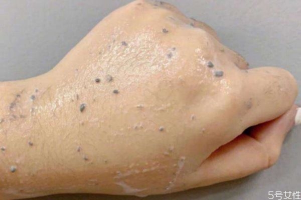 去角質(zhì)慕斯的好處 去角質(zhì)慕斯的原理 去角質(zhì)慕斯的好處 去角質(zhì)慕斯的原理